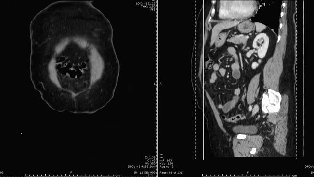 CT scan / CTA abdominal aorta  . medical technology concept.