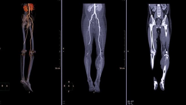 computed tomography angiography, CTA of lower extremity , CTA femoral artery run off ,3D rendering image ,MIP,Coronal view.