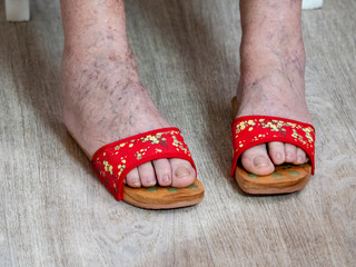 An elderly woman shows her aching legs with cracked vessels and veins. Phlebeurysm.