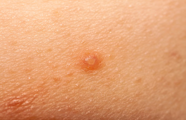 Fototapeta premium Close up of Molluscum Contagiosum also called water wart
