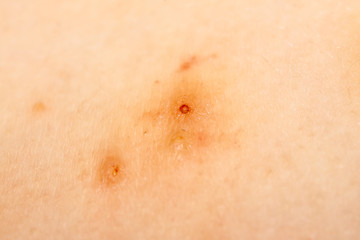 Fototapeta premium Close up of Molluscum Contagiosum also called water wart