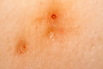 Close up of Molluscum Contagiosum also called water wart - obrazy, fototapety, plakaty