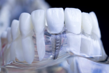 Fototapeta na wymiar Dentist dental teeth implant