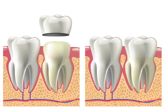 Dental crown installation process. Dental care concept.