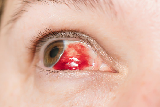 Subconjunctival hemorrhage - hyposphagma. Closeup of woman's face showing red bloodshot eye with browm iris, looked up and left