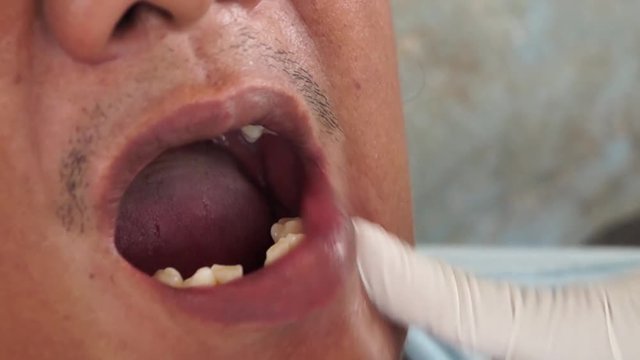 dental tooth extraction of male patient