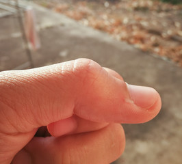Fingers and nails Paronychial of nail