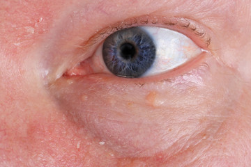 Sore dry skin and blind eye on the face of an old elderly man