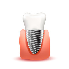 Realistic tooth implant with metallic screw in pink gum isolated on white