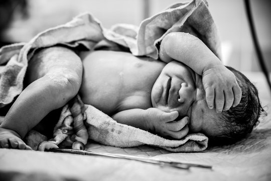 A newborn with a freshly cut umbilical cord lies on a table in the operating room.
