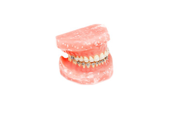 Metall wire dental braces on teeth orthodontic model, isolated