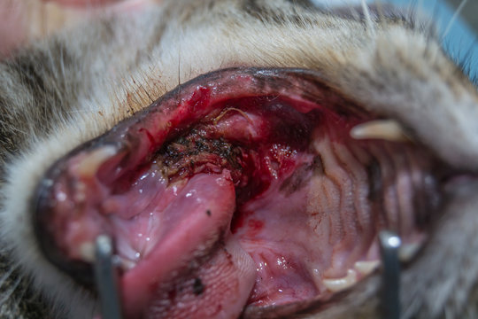 Oral tumor removing