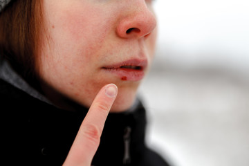 Oral herpes concept