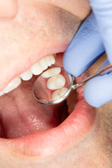 two chewing side teeth of the upper jaw after treatment of caries. Restoration of the chewing...