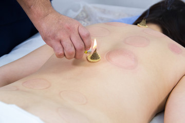 A woman taking a treatment of alternative medicine. Moxo therapy procedure. Heating reflexology points with wormwood cigars. Professional therapist doing traditional chinese therapy - heating
