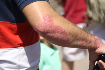 Brazo de hombre con psoriasis.