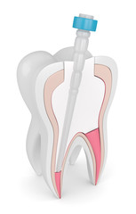 3d render of tooth with gutta percha, fiber post and filling