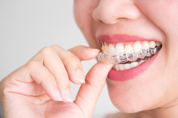 A smiling woman holding invisalign or invisible braces, orthodontic equipment - obrazy, fototapety, plakaty