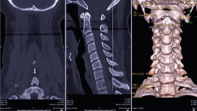 CT SCAN of Cervical Spine ( C-spine ) patient trauma case coronal plane vs sagittal plane and 3D rendering image  Rotating on the monitor . Medical technology concept.