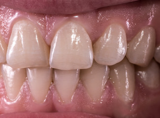Healthy human teeth - incisors, frontal close up view