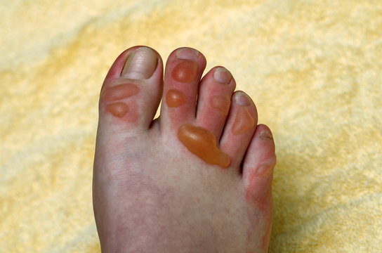 blistered toes resulting from hot water burn