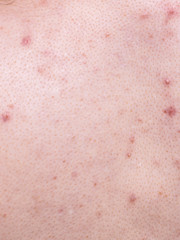 Fototapeta premium Closeup human skin with problem