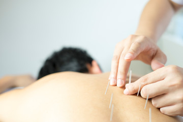 acupuncture treat concept - obrazy, fototapety, plakaty