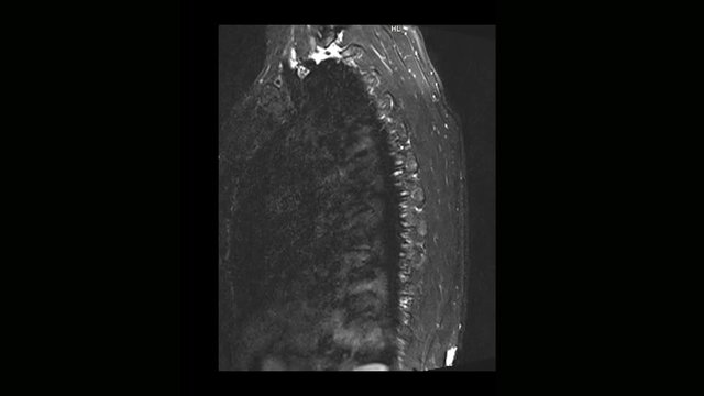Computed medical tomography MRI scan of the thoracic spine of a man with osteochondrosis