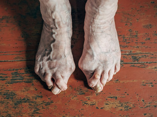 Foot which have bunion (hallux valgus) problem on  floor