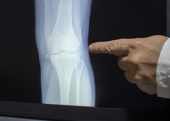 An xray of a knee with a doctor's hand