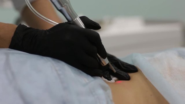 Removal of benign tumors in Cosmetic salon. The use of liquid nitrogen in dermatology.