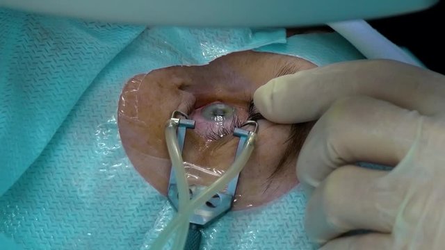 The Patient's Eye is Exposed to a Laser. Ophthalmology Surgery. laser Method of Vision Correction. Close-up