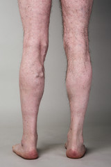 Tight varicose vein on a mans legs