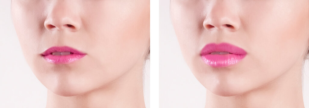 lips before and after augmentation