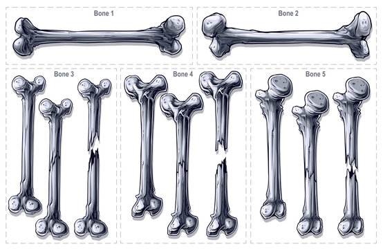Detailed graphic realistic black and white different isolated broken human bones. On white background. Vector icon set.