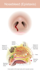 Bleeding from the sinuses is caused by the tear of the arteries within the nasal cavity.