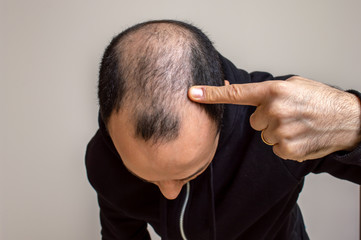 Young man showing his baldness - obrazy, fototapety, plakaty