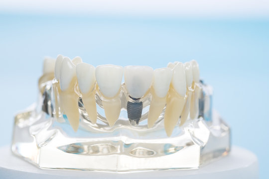 implant and orthodontic model for student to learning teaching model showing teeth.