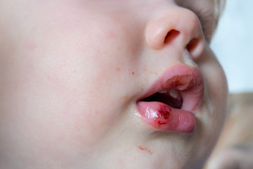 Close-up of baby bruised injured lip after falling. Children traumas concept