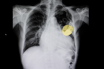 chest film of a patient with cardiac pacemaker