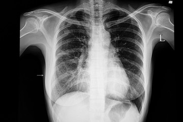 Pneumonia chest film