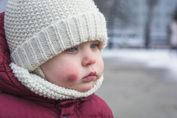 Sad and frightened little boy with bruise injury on face winter outside. abuse and bullying concept. Domestic Family violence and aggression.