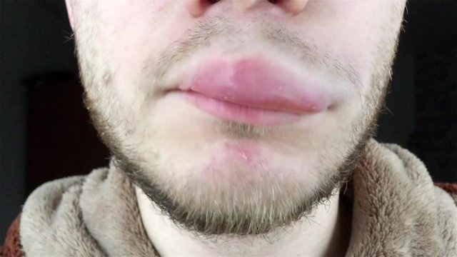  allergic reaction in a man on the lip. Angioedema. Quincke swelling.