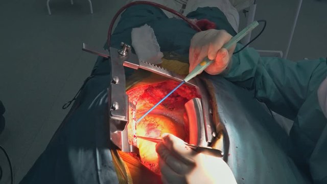 Surgeons working with a scissors on a patient in a heart surgeon open operating theater