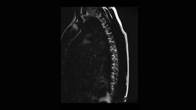 Computed medical tomography MRI scan of the thoracic spine of a man with osteochondrosis