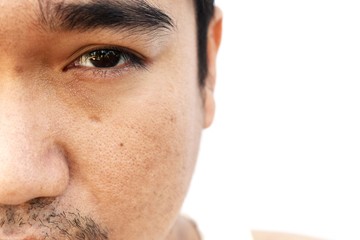 Fototapeta premium asian man face skin after not get a wink of sleep and do not take care for a long time