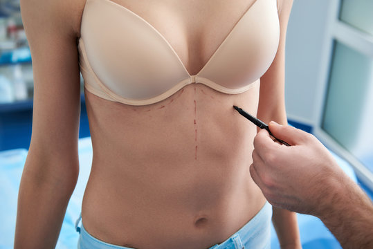 Surgeon drawing dotted line on female patient body while using marker