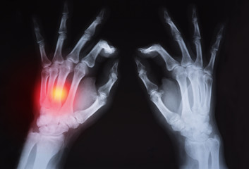 Human's hand's x ray highlighted in red