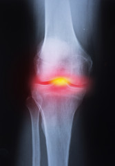 Medical x-ray knee joint image with arthritis ( Gout , Rheumatoid arthritis , Septic arthritis , Osteoarthritis knee )