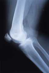 medical X ray image of knee